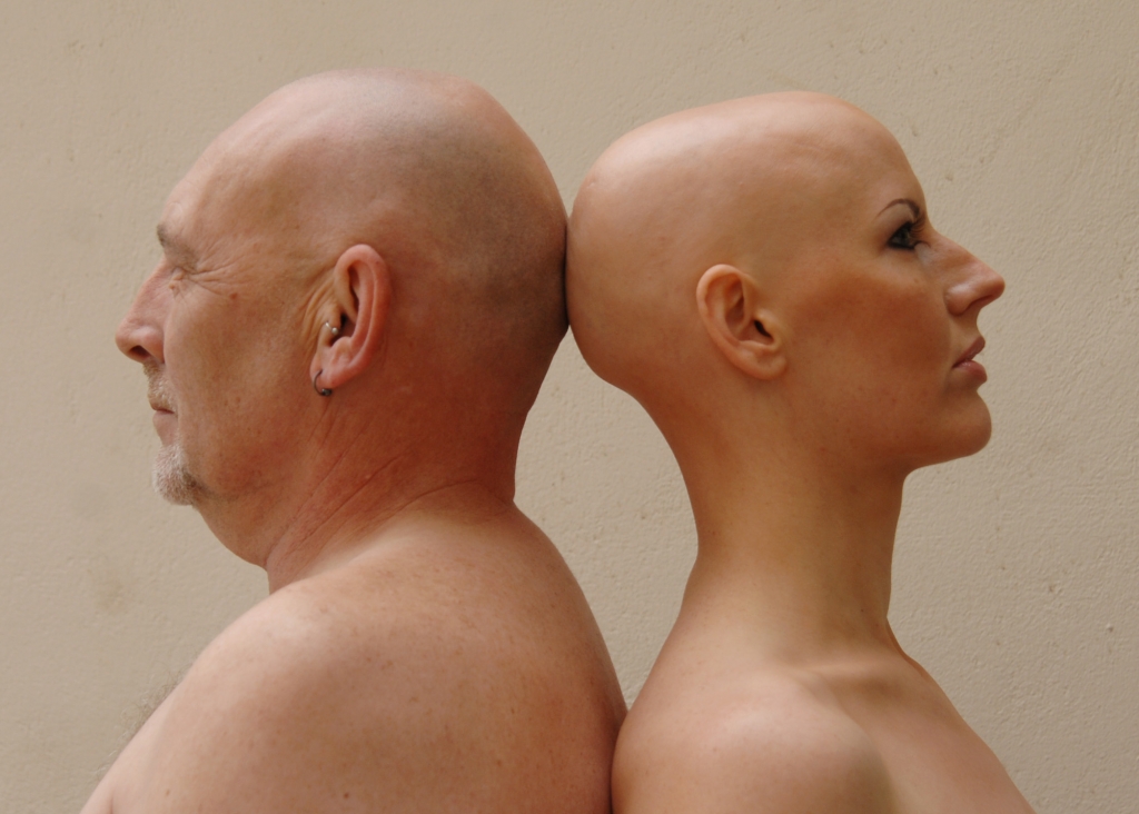 Alopecia Universalis