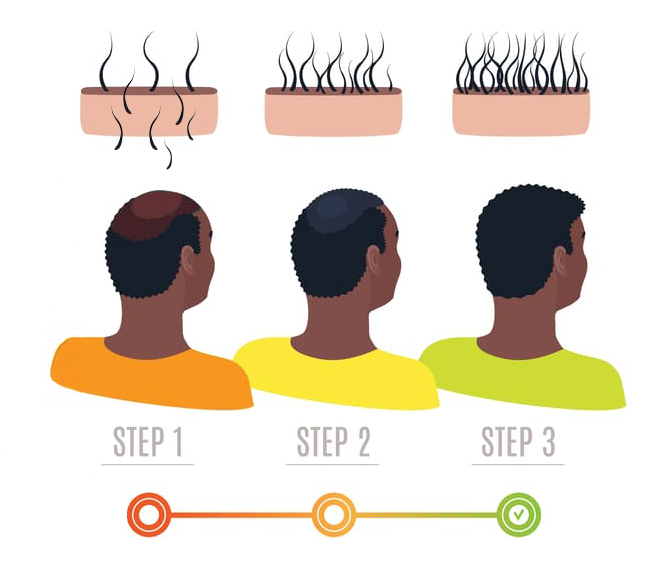 Hair growth stages after hair transplant