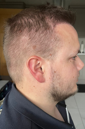 Scott's right side view after the FUE