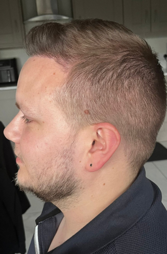 Scott's left side view after the FUE