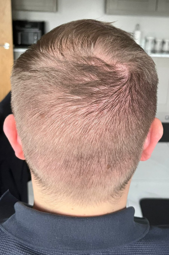 Scott's back view after the FUE