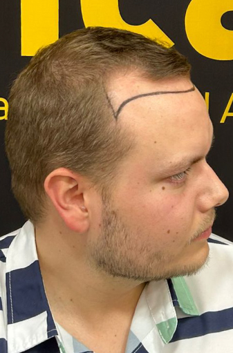 Scott's right side view before the FUE