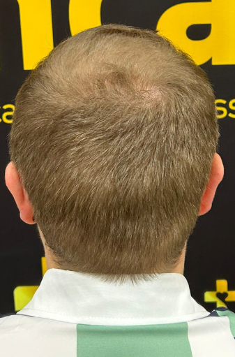 Scott's back view before the FUE