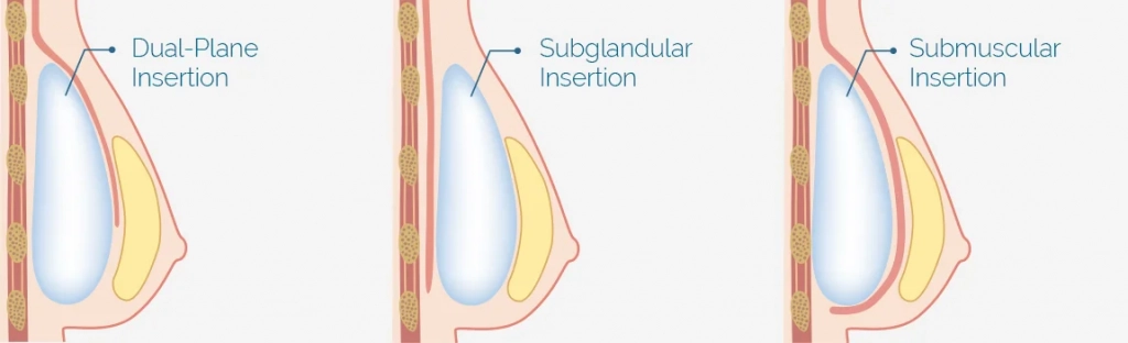 submuscular type 1