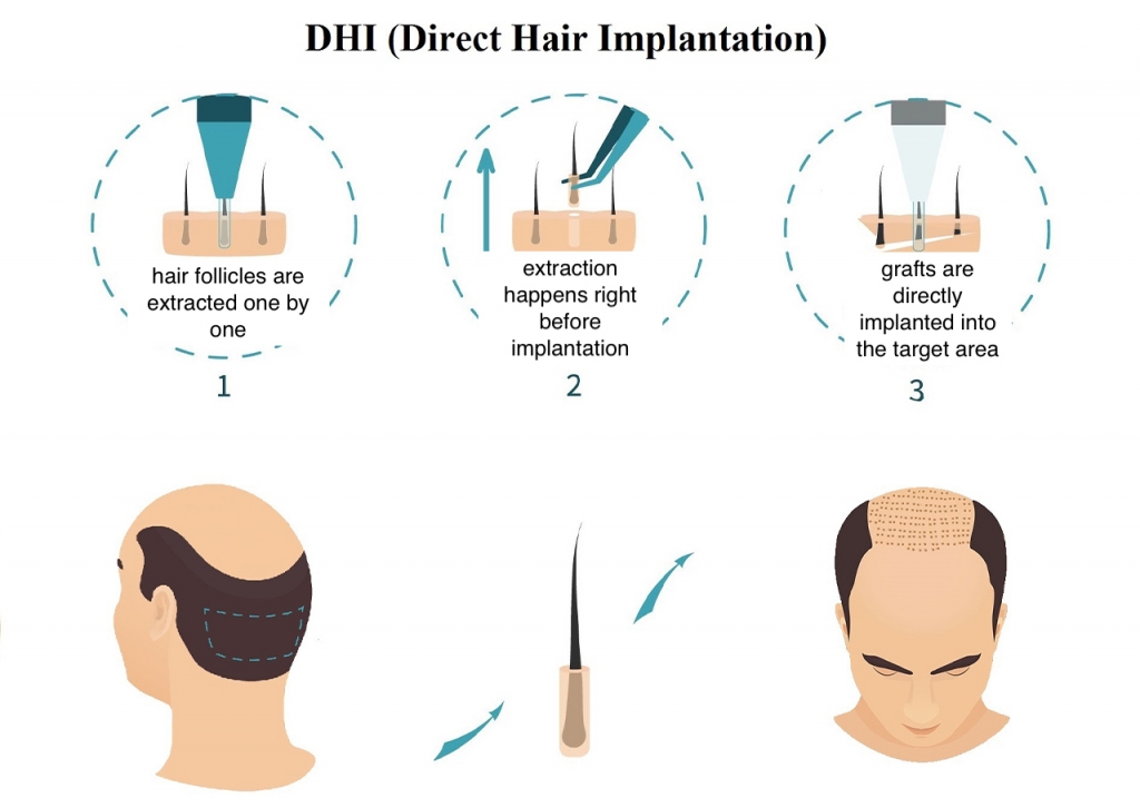 DHI Hair Transplantation 1