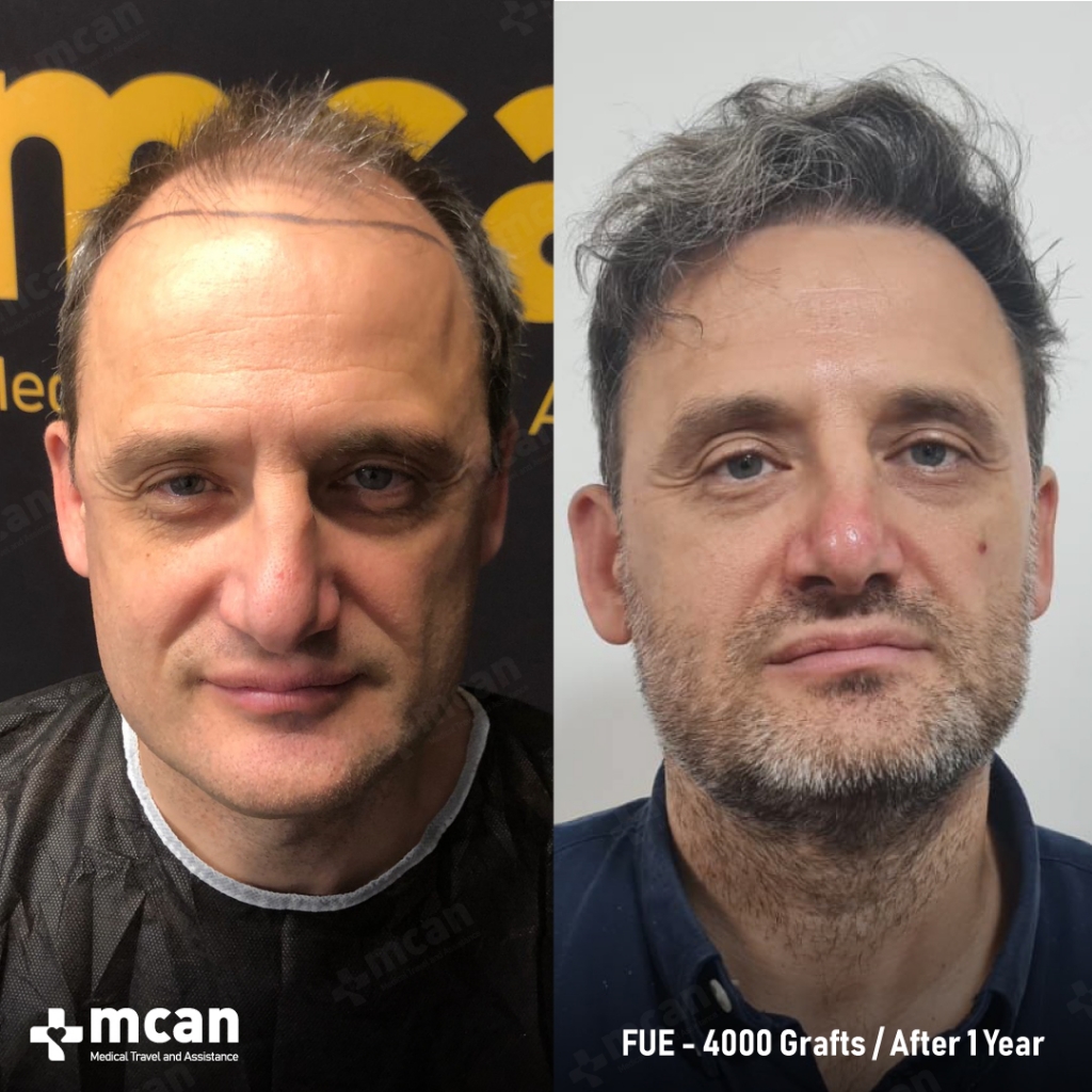 FUE 4000 Grafts Konstantinos K. 1 Year After