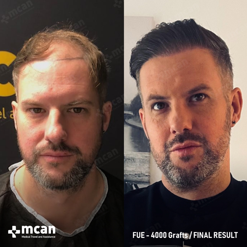 Hair Transplant Before After Ben M. FUE 4000 Grafts Final Result