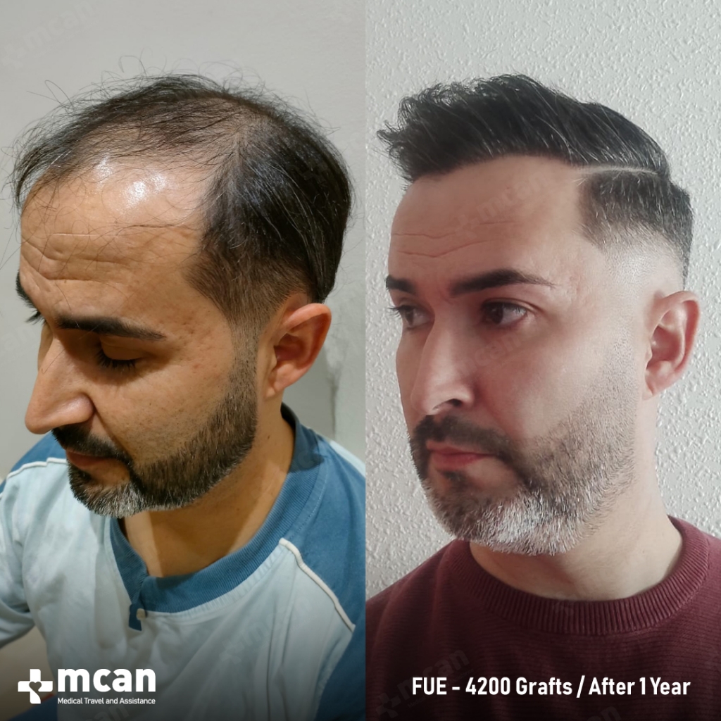 Juan M. FUE 4200 Grafts 1 Year Before After