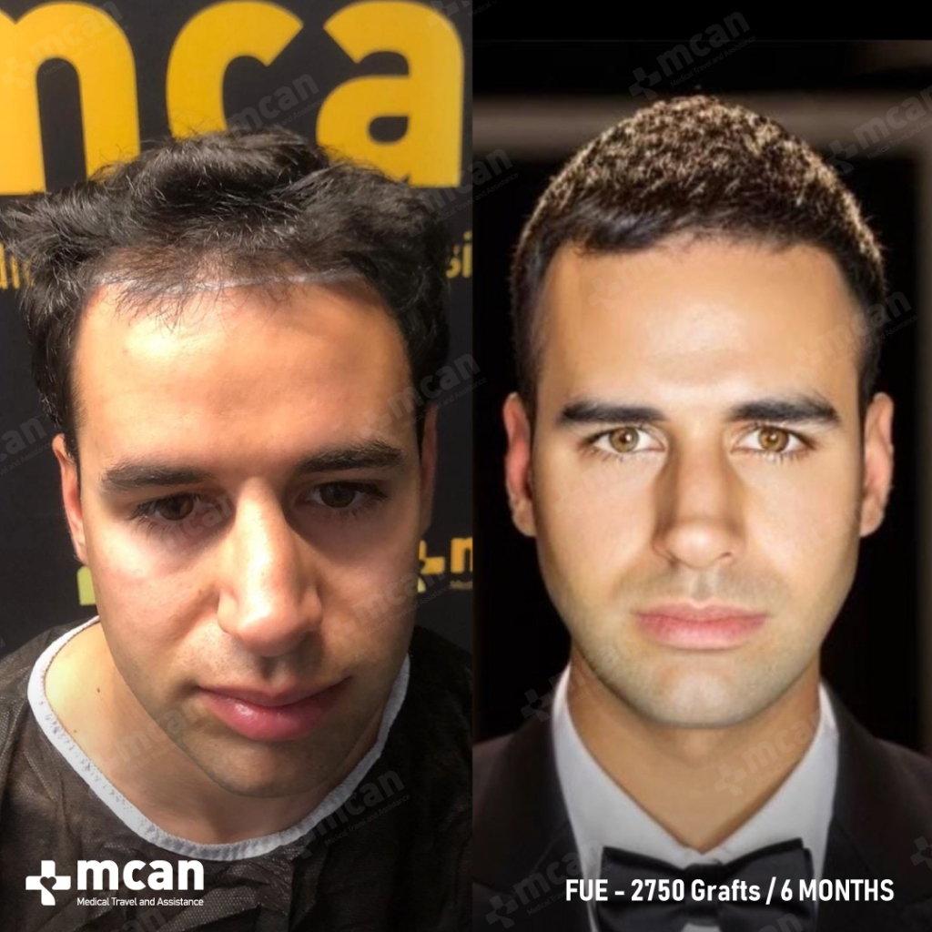 6 Months Before & After MCAN Health Hair Transplant Patient