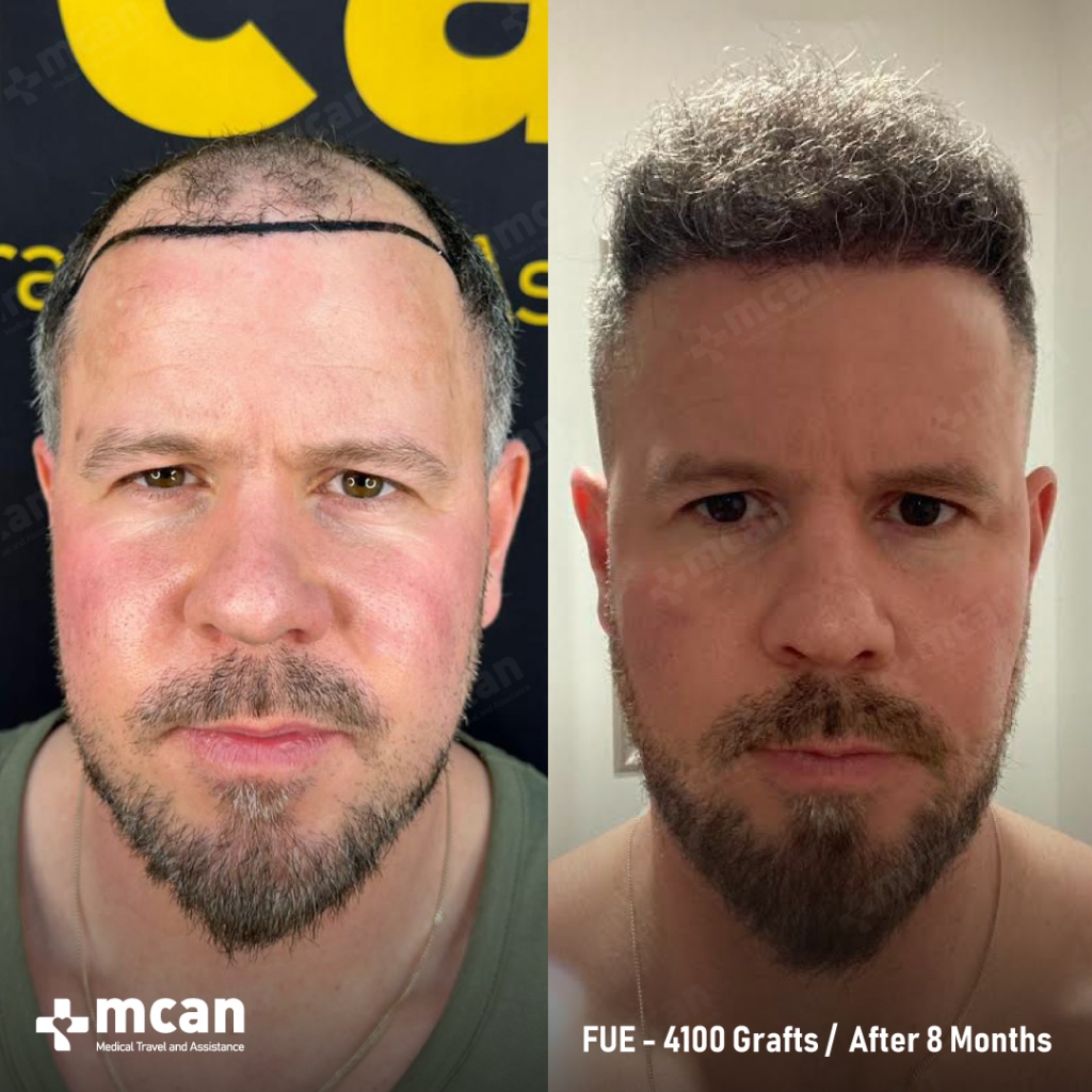 Michael H. FUE 4000 Grafts 8 Months After