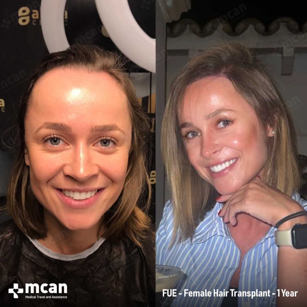 Robin B. Female Hair Transplant After 1 Year