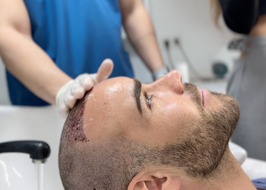 Hair Transplant Aftercare in Turkey: Hair Wash of a patient