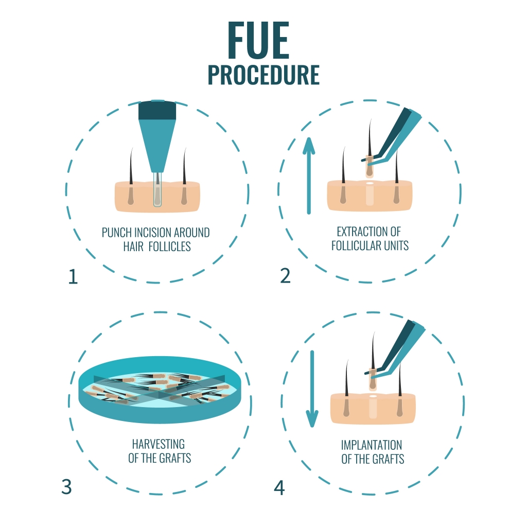 Stages of an FUE procedure