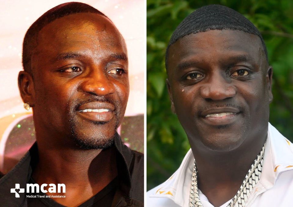 Akon Hair Transplant Before After