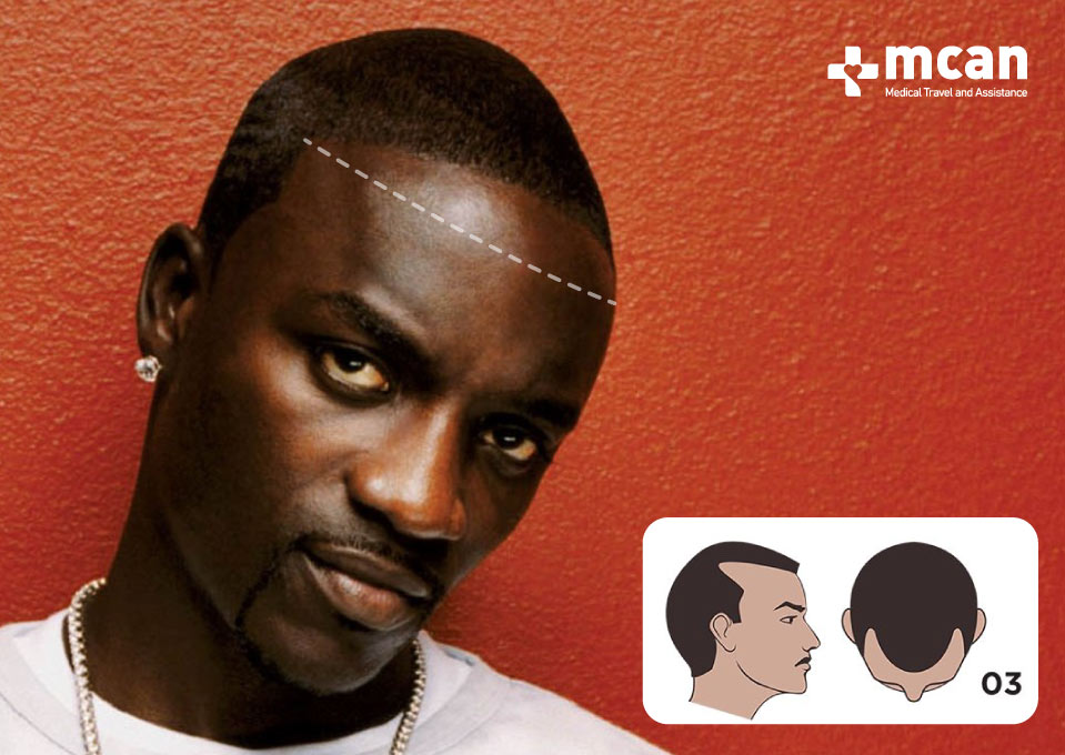 Akon Norwood Scale