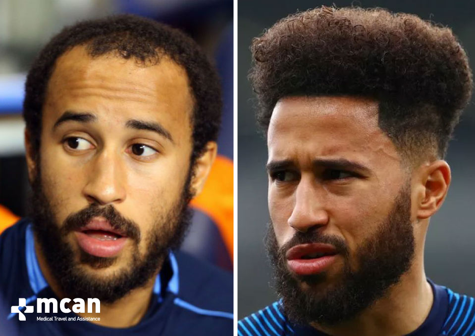 Andros Townsend Before After Hair Transplant