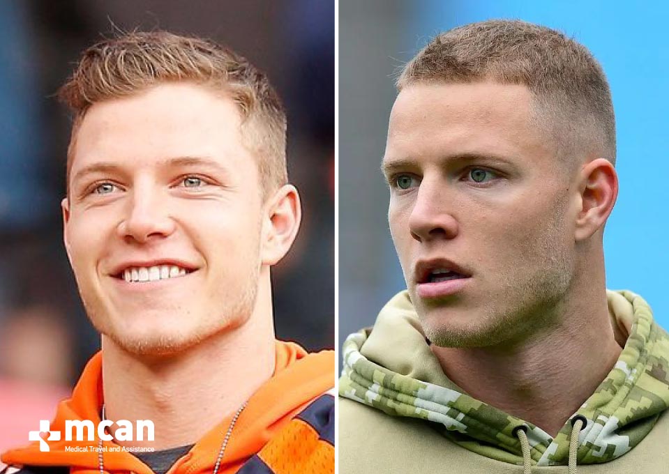 Christian McCaffrey Hair Transplant Before After