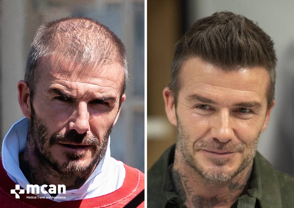 David Beckham Before After