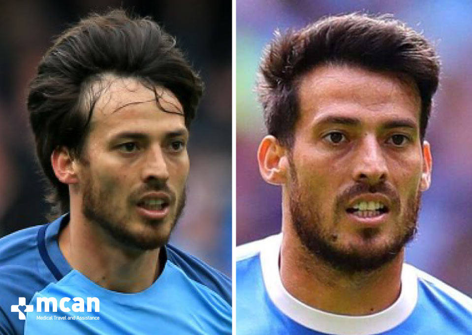 David Silva Hair Transplant Before After