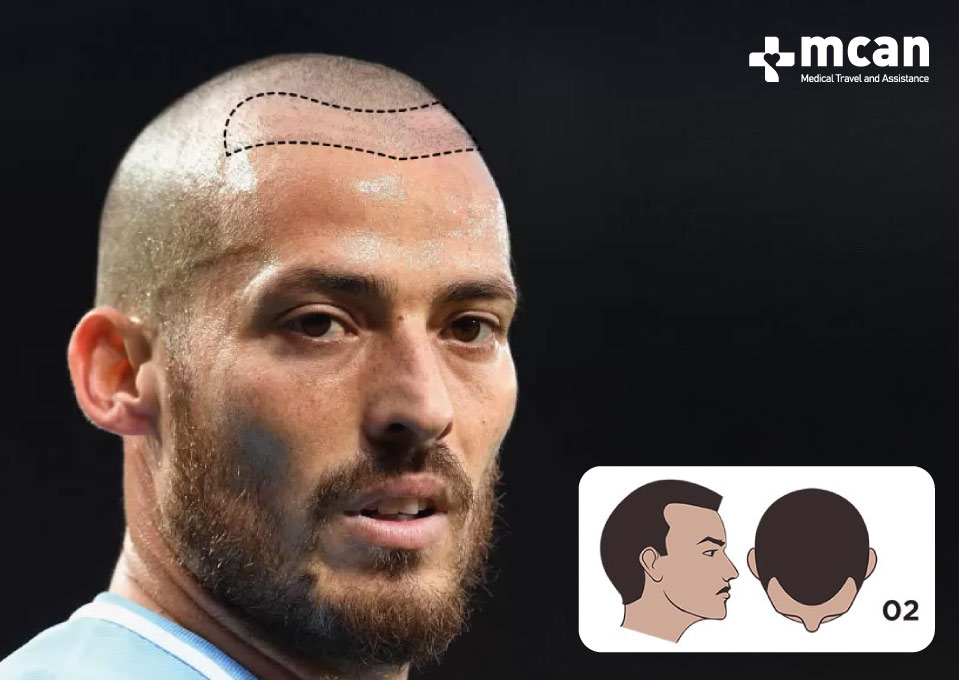 David Silva Norwood Scale 2 Hair Loss