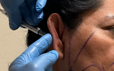 Ear Reshaping