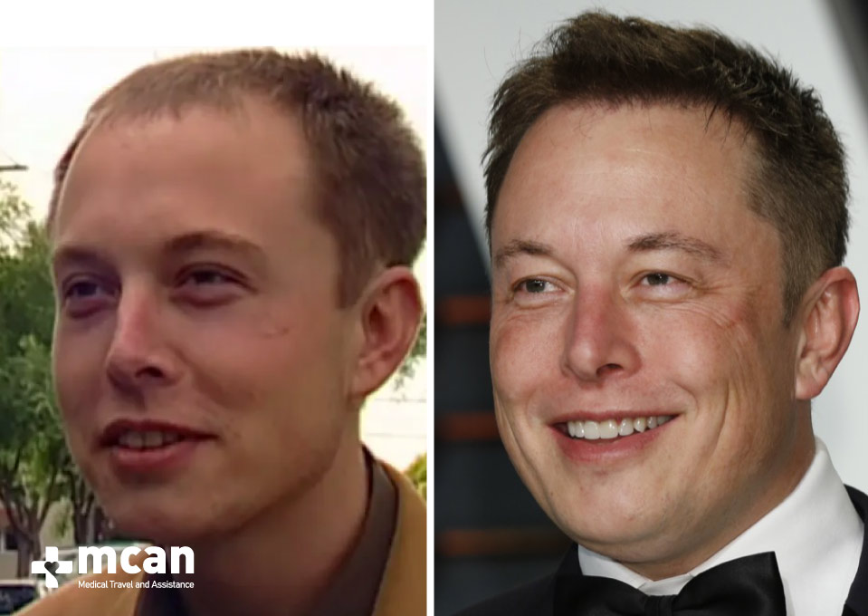 Elon Musks Hair Transplant Before After