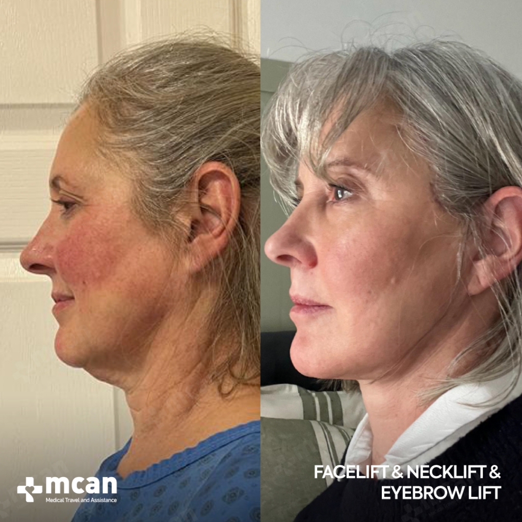 Facelift Before After 1