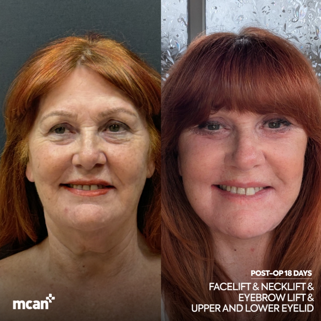 Facelift Before After 10