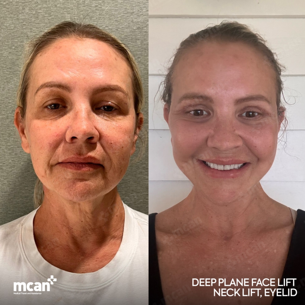 Facelift Before After