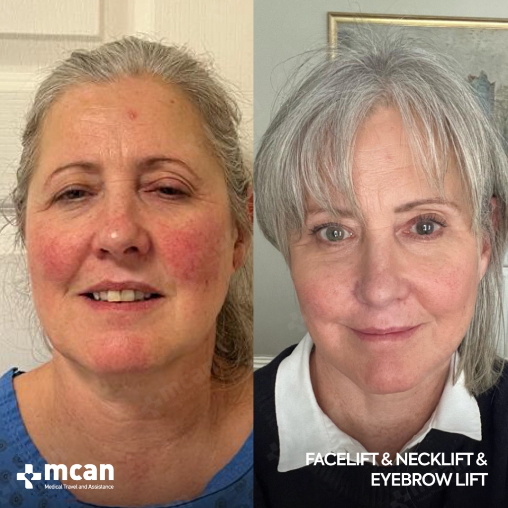 Facelift Before After 2