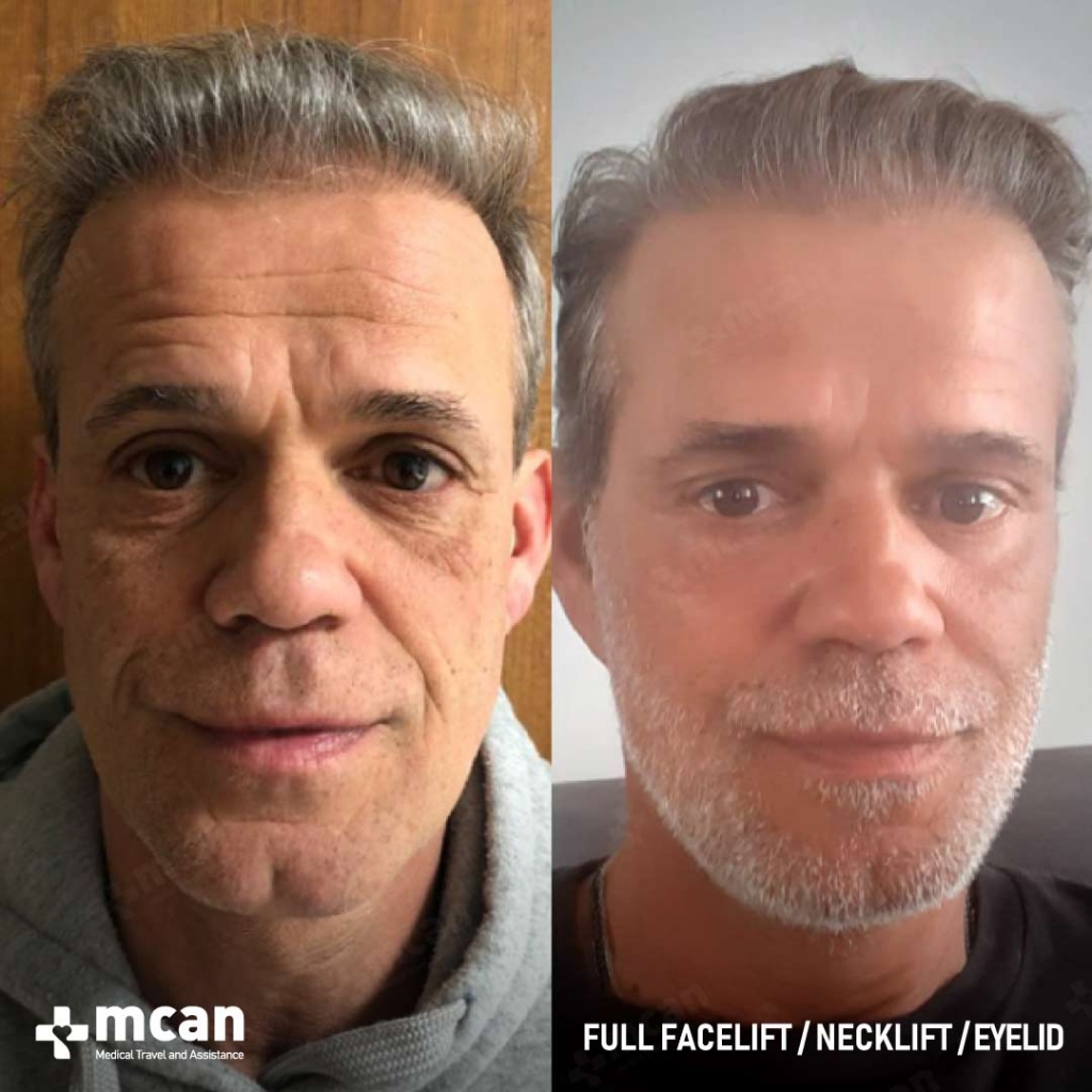 Facelift Before After 4