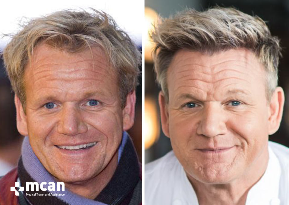 Gordon Ramsay Hair Transplant Before After