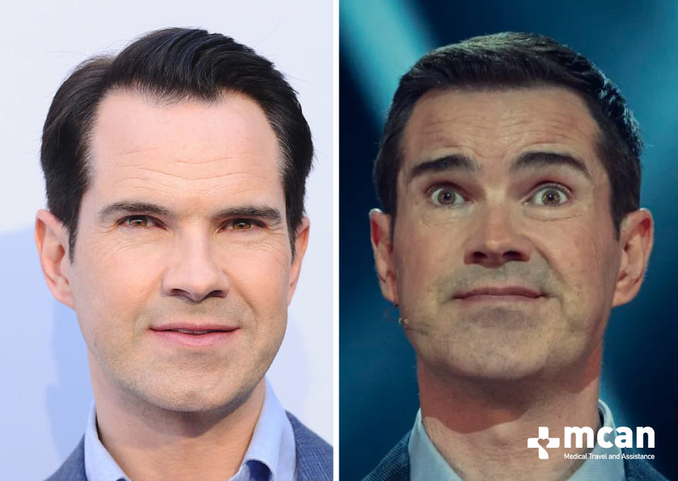 Jimmy Carr Hair Transplant Before After