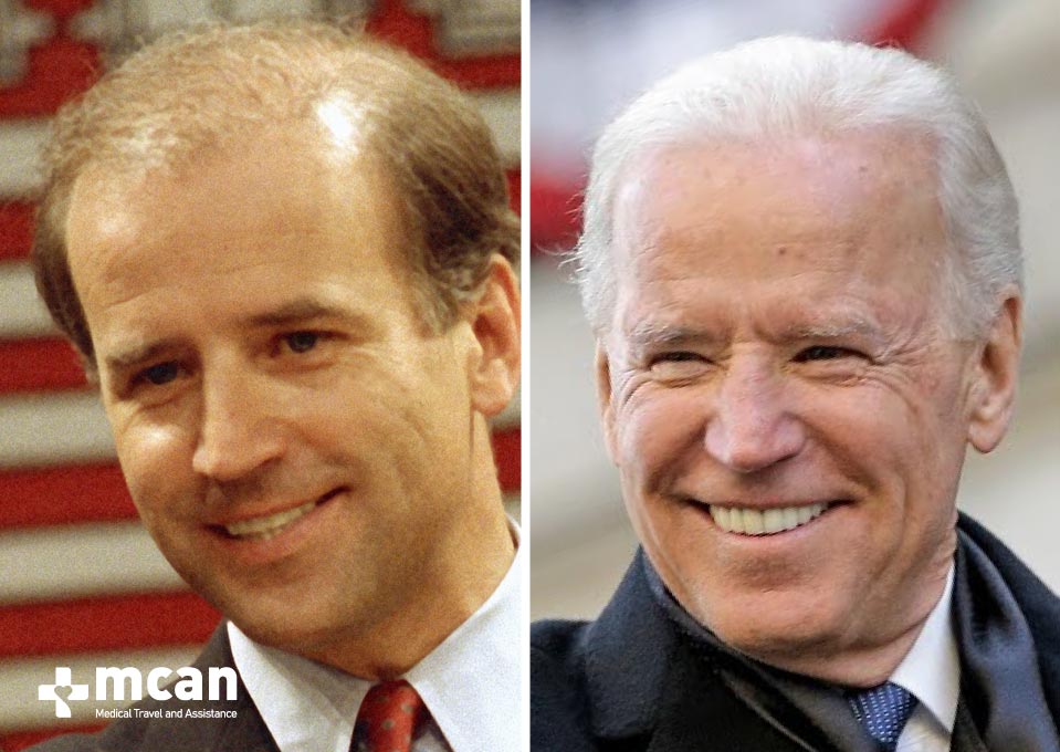 Joe Biden Hair Transplant Before After