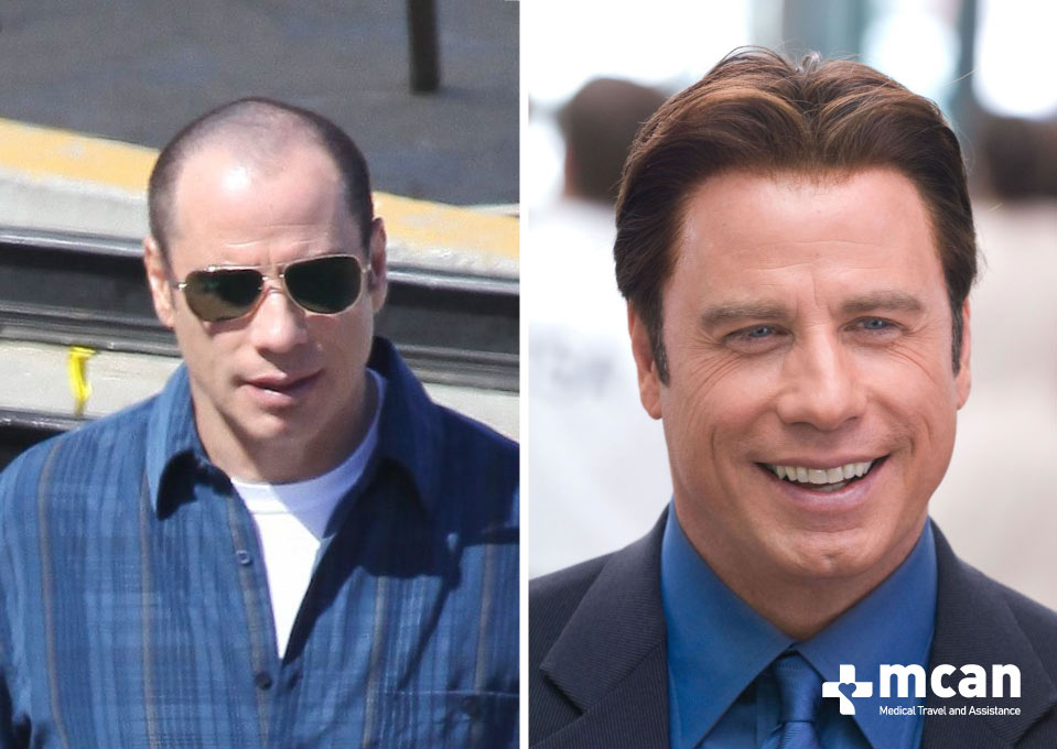 John Travolta Hair Transplant Before After