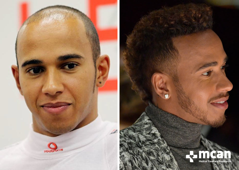 Lewis Hamilton Hair Transplant Before After