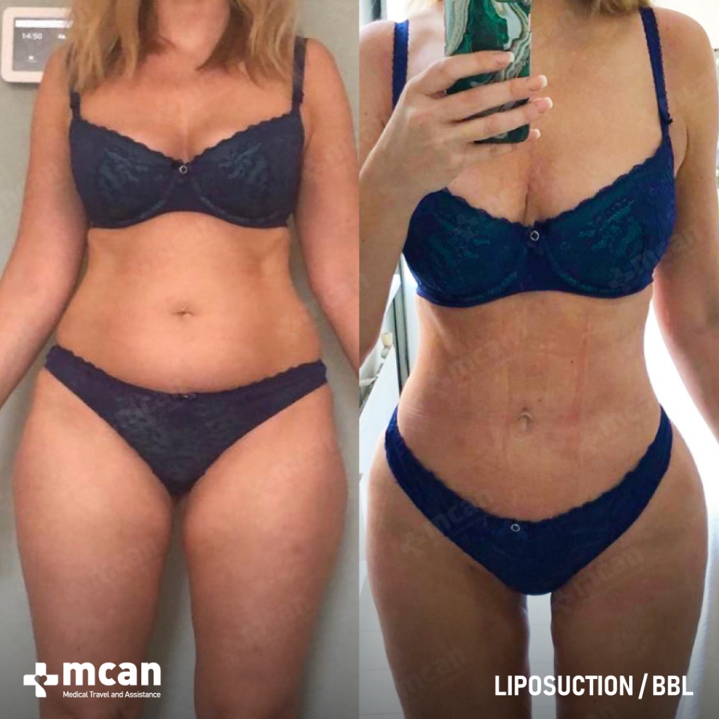 Liposuction Results Before After 1