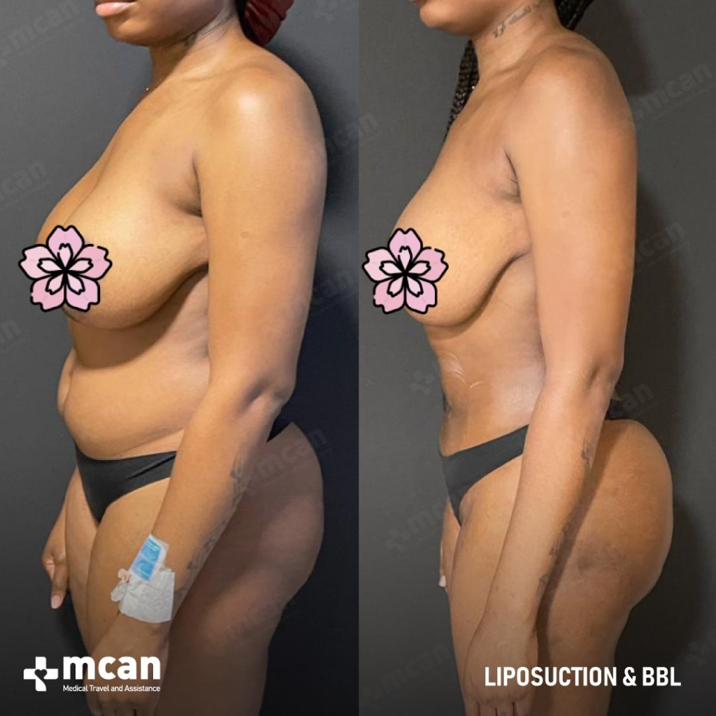 Liposuction Results Before After 14