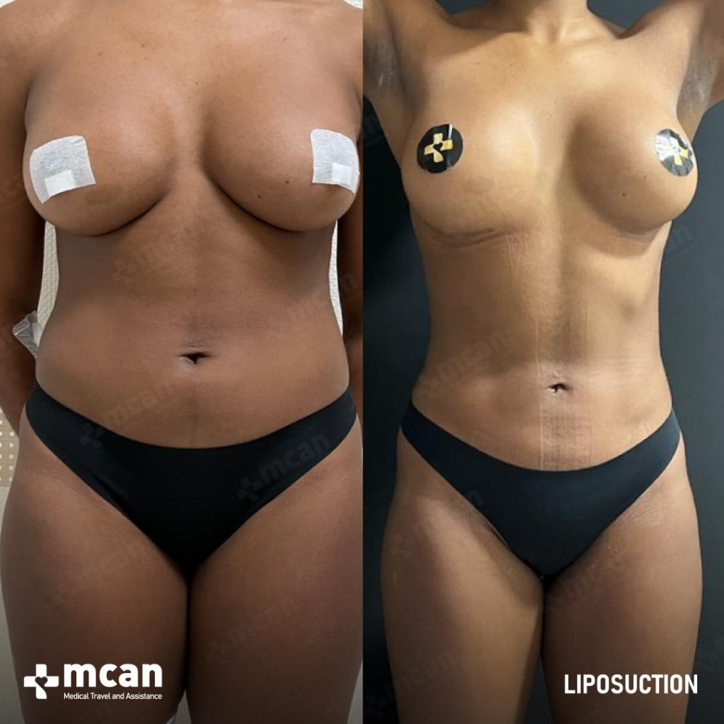 Liposuction Results Before After 15