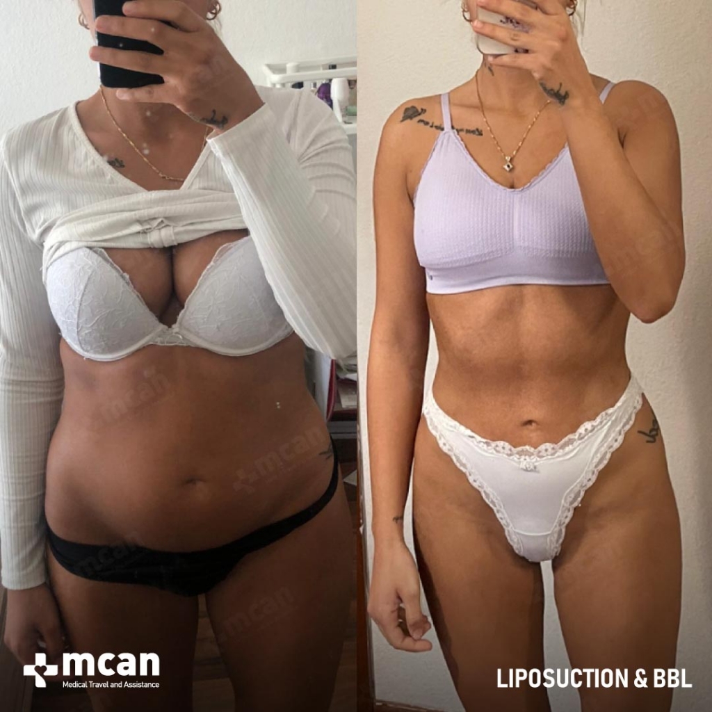 Liposuction Results Before After 16