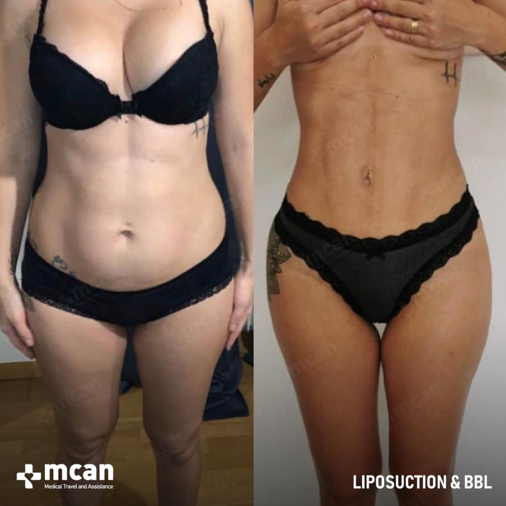 Liposuction Results Before After 17