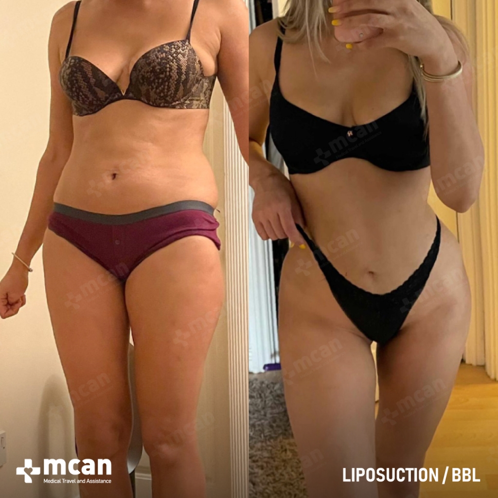 Liposuction Results Before After 2