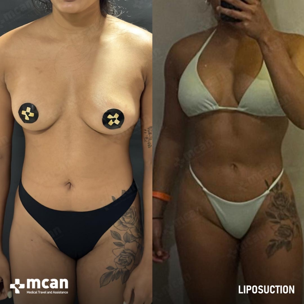 Liposuction Results Before After 22