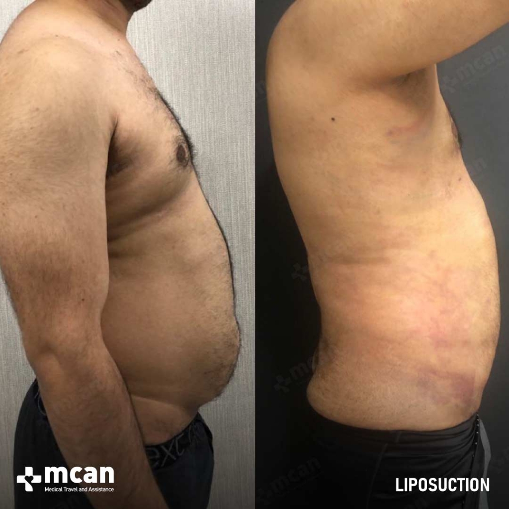 Liposuction Results Before After 24