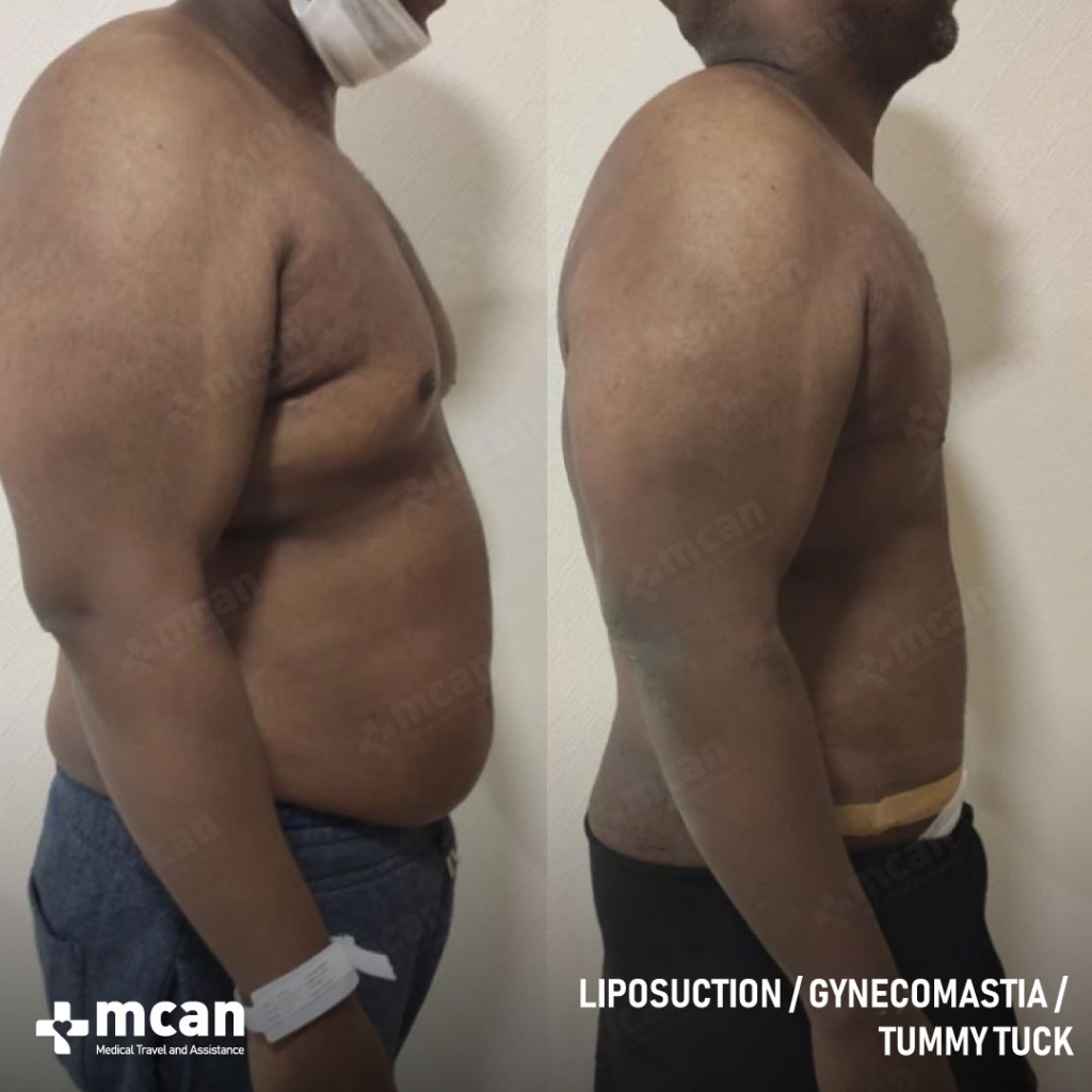 Liposuction Results Before After 25