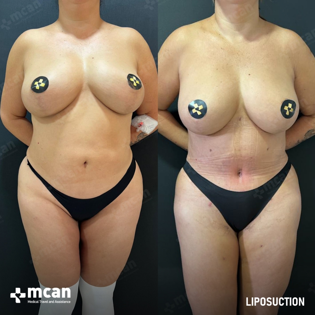 Liposuction Results Before After 26