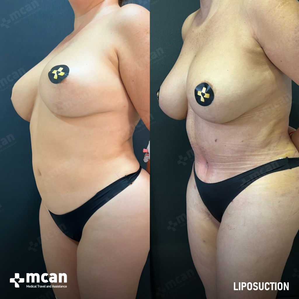 Liposuction Results Before After 27