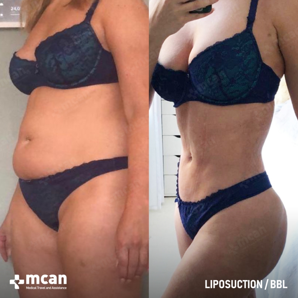 Liposuction Results Before After 3