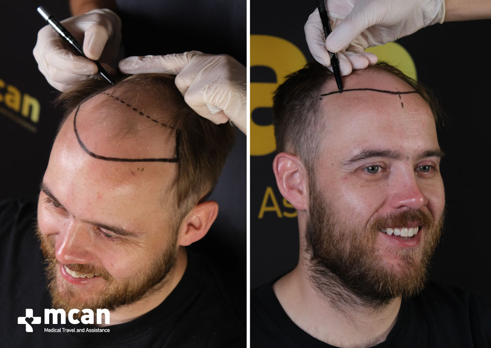 MCAN Health Hair Transplant Before After