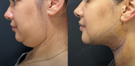 Neck Liposuction